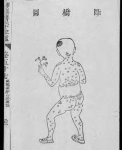 illustration of a man's back and buttocks covered in small pox sores